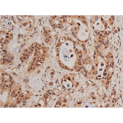 Phospho-FOXO1A (Ser319) Antibody - AF3418 at 1/200 staining human colon cancer tissue sections by IHC-P.