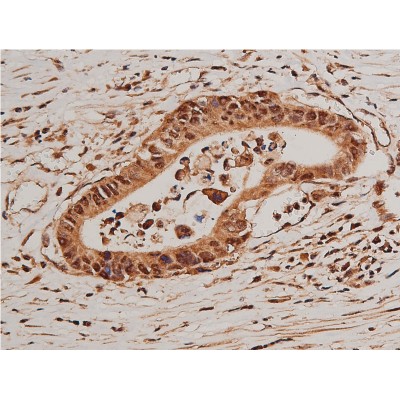Phospho-FOXO1A (Ser319) Antibody - AF3418 at 1/50 staining human colon cancer tissue sections by IHC-P.