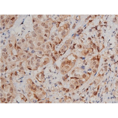 STAT3 Antibody - AF6294 at 1/200 staining human breast cancer tissue sections by IHC-P.