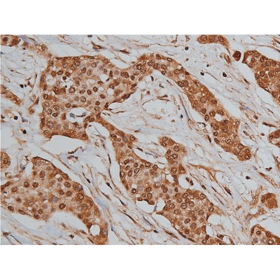 BMP3 Antibody - AF5153 at 1/200 staining human liver cancer tissue sections by IHC-P.