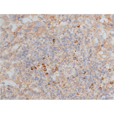 MMP9 Antibody - AF5228 at 1/50 staining human breast cancer tissue sections by IHC-P.