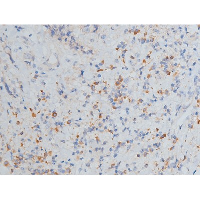 MMP9 Antibody - AF5228 at 1/200 staining human breast cancer tissue sections by IHC-P.
