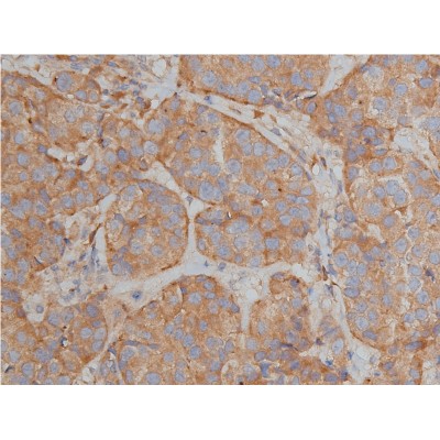 Bim Antibody - AF5292 at 1/200 staining human breast cancer tissue sections by IHC-P.