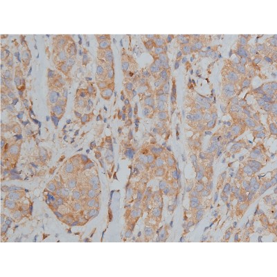 Bim Antibody - AF5292 at 1/200 staining human breast cancer tissue sections by IHC-P.