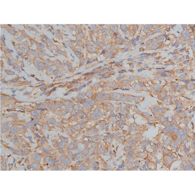 Bim Antibody - AF5292 at 1/200 staining human breast cancer tissue sections by IHC-P.