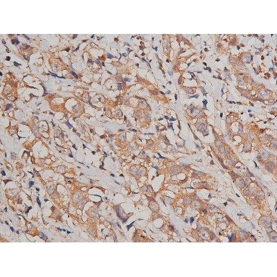 Catenin gamma Antibody - AF5494 at 1/200 staining human breast cancer tissue sections by IHC-P.