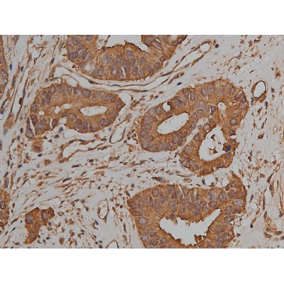 Catenin gamma Antibody - AF5494 at 1/50 staining human colon cancer tissue sections by IHC-P.
