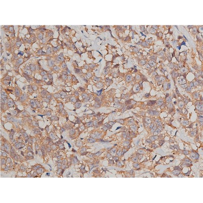 Catenin gamma Antibody - AF5494 at 1/200 staining human breast cancer tissue sections by IHC-P.