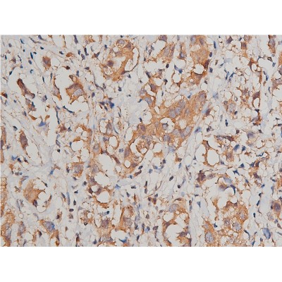 Catenin gamma Antibody - AF5494 at 1/200 staining human breast cancer tissue sections by IHC-P.