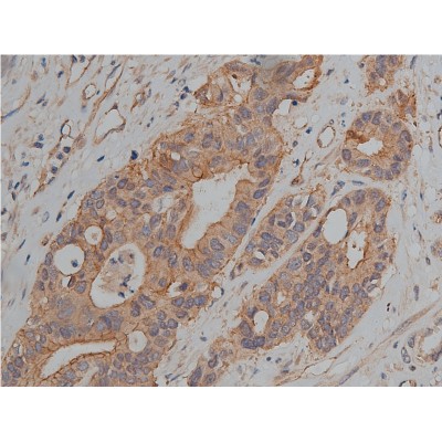 Catenin gamma Antibody - AF5494 at 1/200 staining human colon cancer tissue sections by IHC-P.