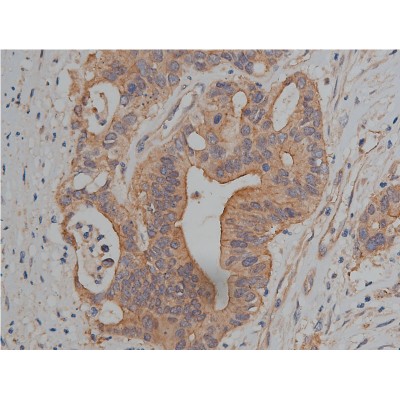 Catenin gamma Antibody - AF5494 at 1/200 staining human colon cancer tissue sections by IHC-P.