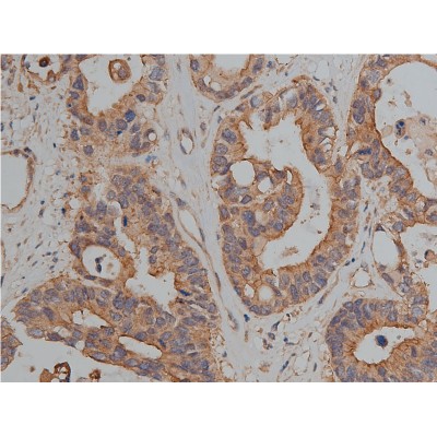 Catenin gamma Antibody - AF5494 at 1/200 staining human colon cancer tissue sections by IHC-P.