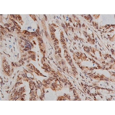 Phospho-AKT1/2/3 (Ser473) Antibody - AF0016 at 1/200 staining human lung cancer tissue sections by IHC-P.