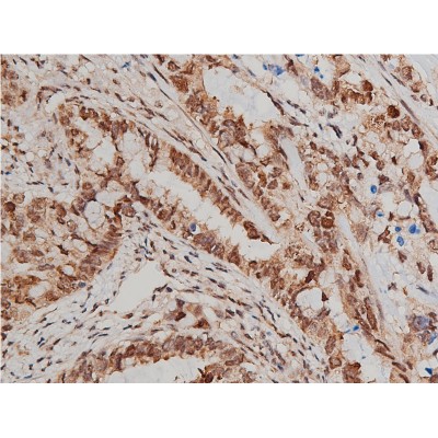 Phospho-AKT1/2/3 (Ser473) Antibody - AF0016 at 1/200 staining human lung cancer tissue sections by IHC-P.