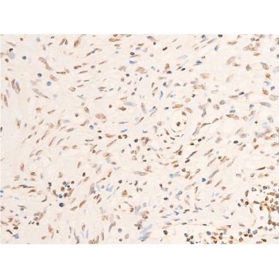 Phospho-JAK1 (Tyr1022)[Tyr1034] Antibody - AF2012 at 1/100 staining human muscle tumor tissue sections by IHC-P.