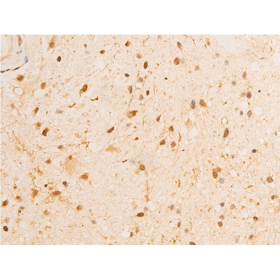 Phospho-GSK3 beta (Ser9) Antibody - AF2016 at 1/100 staining human glioma tissue sections by IHC-P.