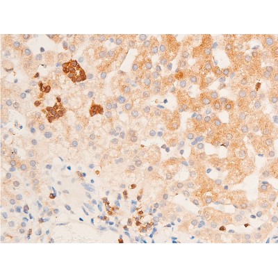 Phospho-Chk1 (Ser317) Antibody - AF3007 at 1/100 staining human vascular cancer tissue sections by IHC-P.