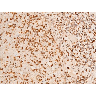 Phospho-Chk2 (Thr383) Antibody - AF3034 at 1/100 staining human TB tissue sections by IHC-P.