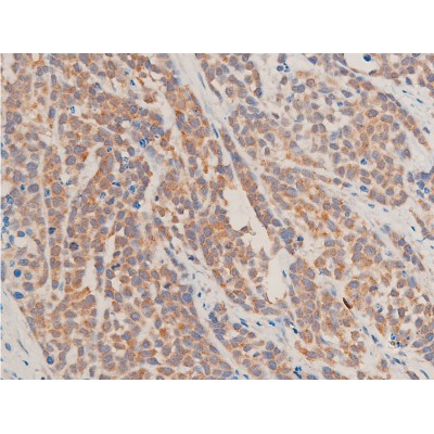 TGF beta 1 Antibody - AF1027 at 1/100 staining rat tumor tissue sections by IHC-P.