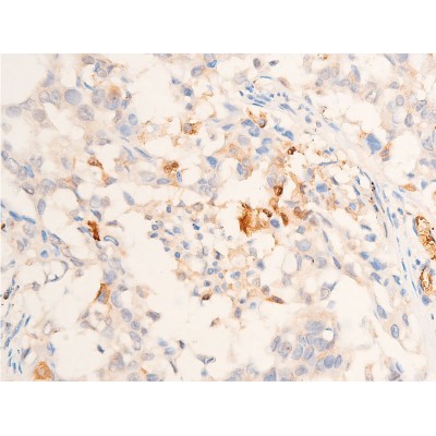 TGF beta 1 Antibody - AF1027 at 1/100 staining human lung cancer tissue sections by IHC-P.