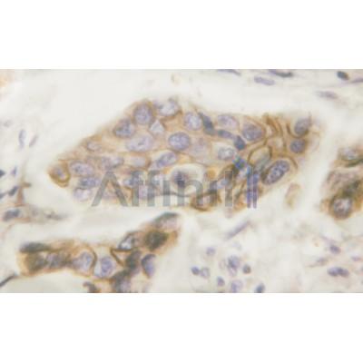 Phospho-EGFR (Tyr992)[Tyr1016] Antibody - AF3043 at 1/100 staining human breast carcinoma tissue by IHC-P.