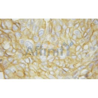 Phospho-ATP1A1 (Ser16) Antibody - AF3083 at 1/100 staining human liver cancer tissue by IHC-P.