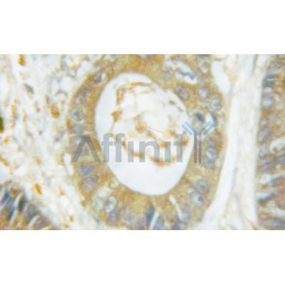 Phospho-NCF1/p47-phox (Ser359) Antibody - AF3167 at 1/100 staining human colon carcinoma tissue by IHC-P.