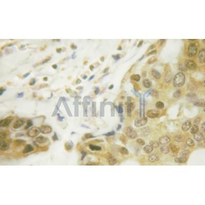 Phospho-NF-kB p65 (Ser281) Antibody - AF3393 at 1/100 staining human breast carcinoma tissue by IHC-P.