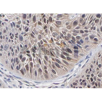 NF-kB p65 Antibody - AF5006 at 1/100 staining Human Breast Cancer tissue sections by IHC-P.
