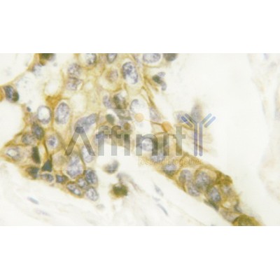 EGFR Antibody - AF6043 at 1/100 staining human breast carcinoma by IHC-P.