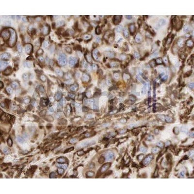 Vimentin Antibody - AF0292 at 1/100 staining Human breast cancer tissue by IHC-P.