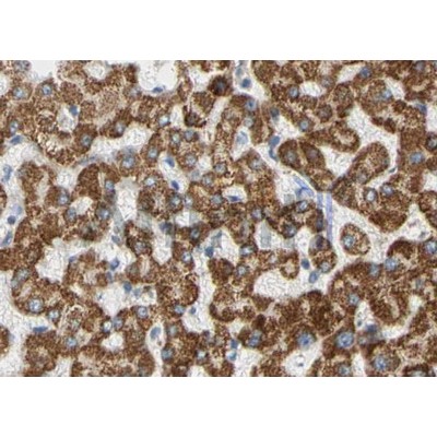 PI3 kinase P110 alpha Antibody - AF5112 at 1/100 staining human liver cancer tissue by IHC-P.