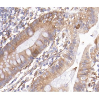 REG3G Antibody - DF6869 at 1/200 staining Human colon cancer tissue sections by IHC-P.
