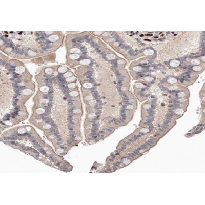mGluR6 Antibody - AF0170 at 1/100 staining human colon carcinoma tissue sections by IHC-P.