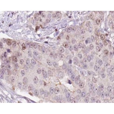 hCG beta Antibody - AF0177 at 1/100 staining human liver carcinoma tissue sections by IHC-P.