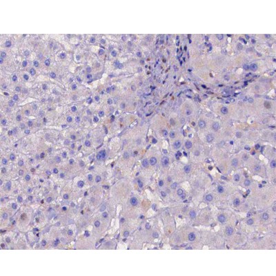 Phospho-IKK beta (Tyr188) Antibody - AF3009 at 1/200 staining human liver cancer tissue sections by IHC-P.