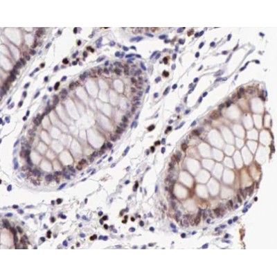 Phospho-IKK beta (Tyr199) Antibody - AF3010 at 1/200 staining human colon cancer tissue sections by IHC-P.