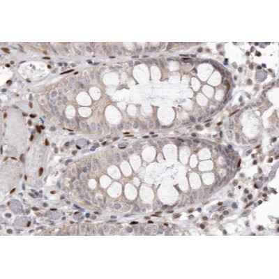 Phospho-EGFR (Tyr1068)[Tyr1092] Antibody - AF3045 at 1/200 staining human colon carcinoma tissue sections by IHC-P.