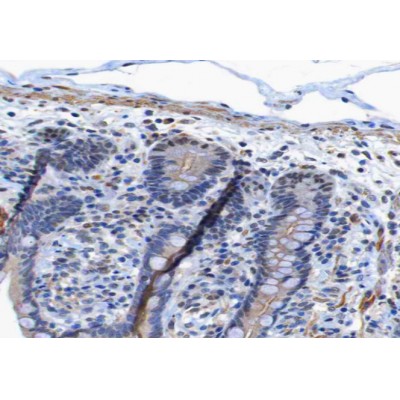 Phospho-EGFR (Tyr1173)[Tyr1197] Antibody - AF3048 at 1/200 staining human colon carcinoma tissue sections by IHC-P.