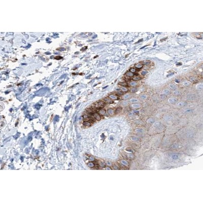 Cytokeratin 16 Antibody - AF0189 at 1/200 staining human skin carcinoma tissue sections by IHC-P.