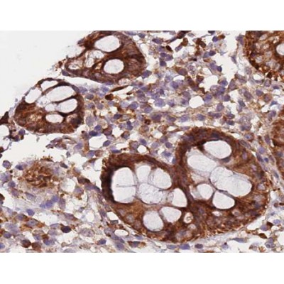 Cytokeratin 20 Antibody - AF0193 at 1/200 staining human colon carcinoma tissue sections by IHC-P.