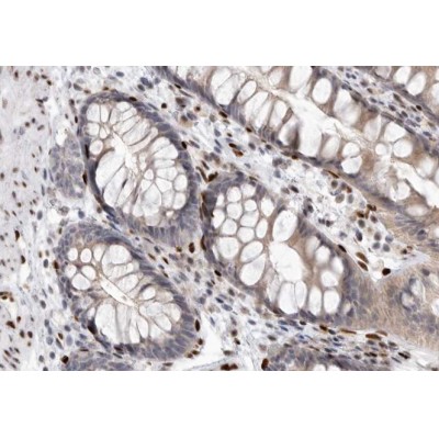 Phospho-eIF4E (Ser209) Antibody - AF3110 at 1/200 staining human colon carcinoma tissue sections by IHC-P.