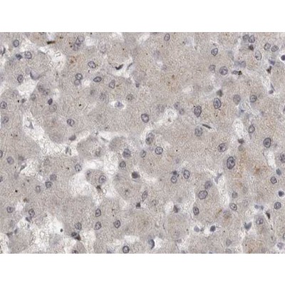 Phospho-MEK1/2 (Ser221)[Ser222] Antibody - AF3385 at 1/200 staining human liver cancer tissue sections by IHC-P.