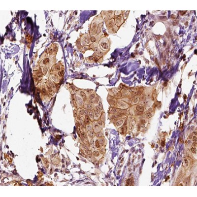 Mammaglobin Antibody - AF0202 at 1/100 staining human breast carcinoma tissue sections by IHC-P.