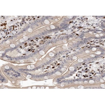 Mammaglobin B Antibody - AF0203 at 1/100 staining human colon carcinoma tissue sections by IHC-P.