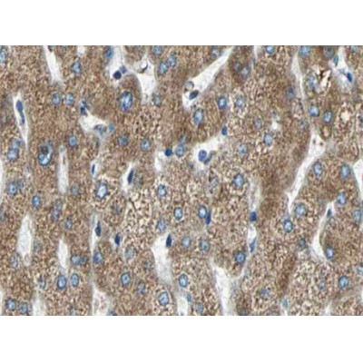 MMP11 Antibody - AF0211 at 1/100 staining human liver carcinoma tissue sections by IHC-P.