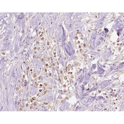 VPS72 Antibody - AF0508 at 1/100 staining human Breast cancer tissue sections by IHC-P.