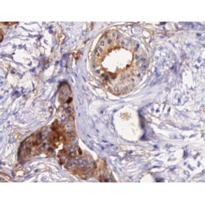STEAP4 Antibody - AF0574 at 1/100 staining human Prostate cancer tissue sections by IHC-P.
