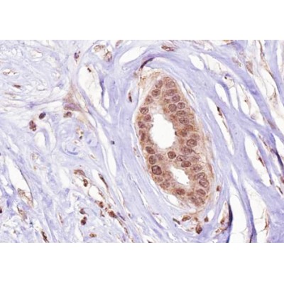 Phospho-Estrogen Receptor alpha (Ser106) Antibody - AF3060 at 1/100 staining human Breast carcinoma tissue sections by IHC-P.