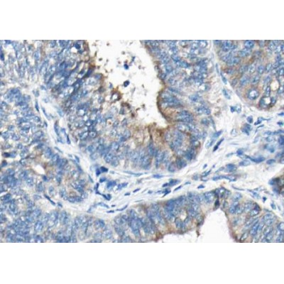 Phospho-Synaptotagmin 1/2 (Ser309) Antibody - AF3223 at 1/100 staining human Thyroid cancer tissue sections by IHC-P.
